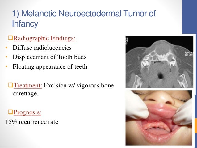 Are floating facial cyst authoritative answer Floating facial cyst